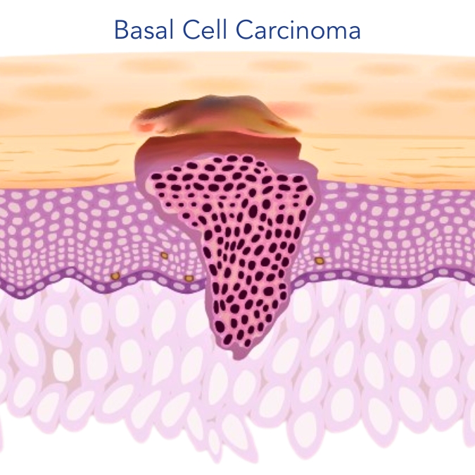 Basal Cell Carcinoma