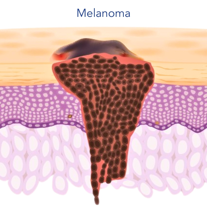 Melanoma