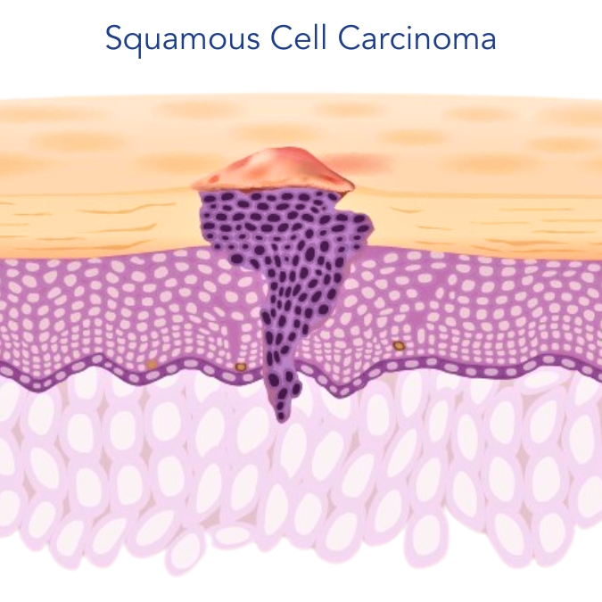 Squamous Cell Carcinoma