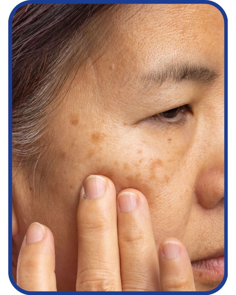 a woman observes her age spots